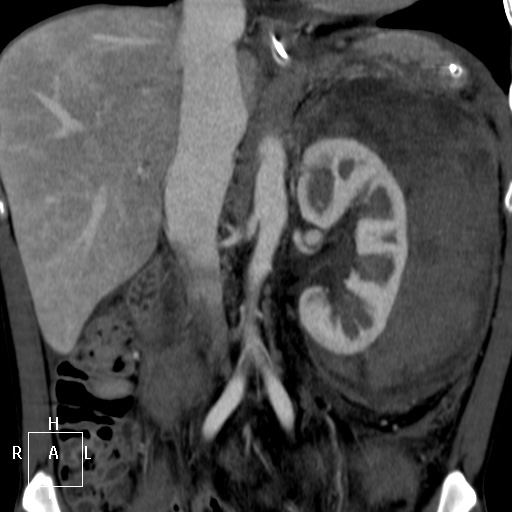 Aorto-left renal vein fistula (Radiopaedia 45534-49628 B 34).jpg