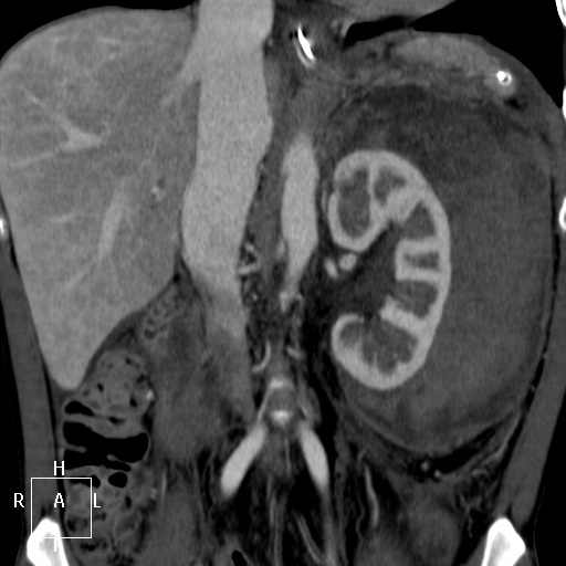 Aorto-left renal vein fistula (Radiopaedia 45534-49628 B 35).jpg