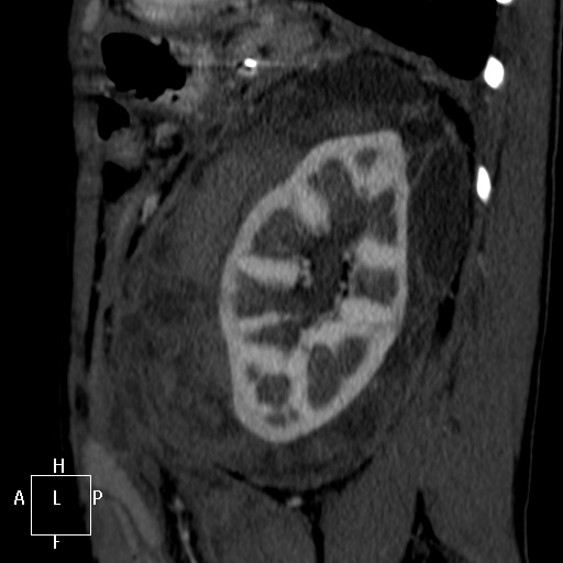 File:Aorto-left renal vein fistula (Radiopaedia 45534-49628 C 58).jpg