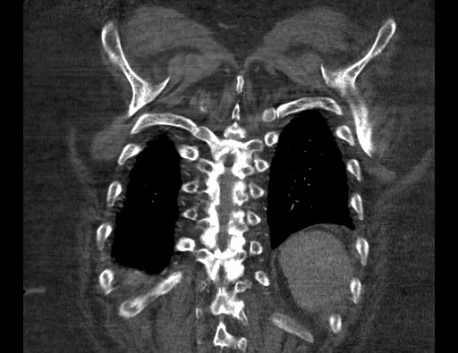 Aortoesophageal fistula with endovascular repair (Radiopaedia 73781-84592 Coronal C+ CTPA 119).jpg