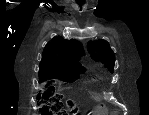 Aortoesophageal fistula with endovascular repair (Radiopaedia 73781-84592 Coronal C+ CTPA 14).jpg