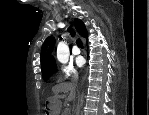 Aortoesophageal fistula with endovascular repair (Radiopaedia 73781-84592 Sagittal C+ CTPA 90).jpg