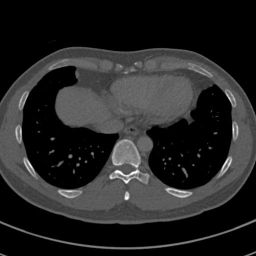 File:Apical lung mass mimic - neurogenic tumor (Radiopaedia 59918-67521 Axial bone window 62).jpg