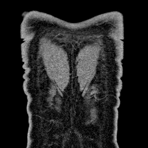 Apical lung mass mimic - neurogenic tumor (Radiopaedia 59918-67521 B 106).jpg