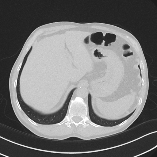Apical pulmonary metastasis (Radiopaedia 46338-50754 Axial non-contrast 58).png