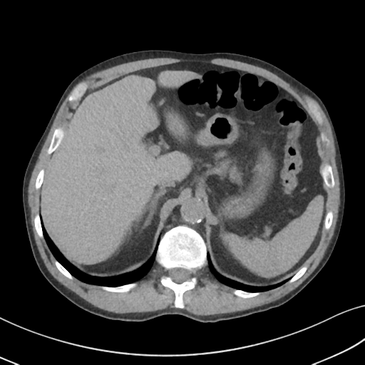 Apical pulmonary metastasis (Radiopaedia 46338-50754 B 61).png