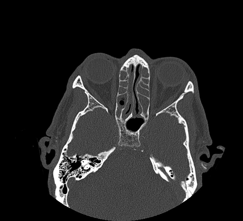 Aplastic maxillary sinuses (Radiopaedia 60030-67561 Axial non-contrast 47).jpg