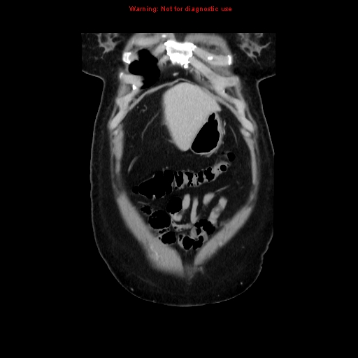 Appendiceal mucinous cystadenoma (Radiopaedia 8263-9111 B 11).jpg