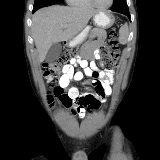 Appendicitis complicated by post-operative collection (Radiopaedia 35595-37113 B 17).jpg