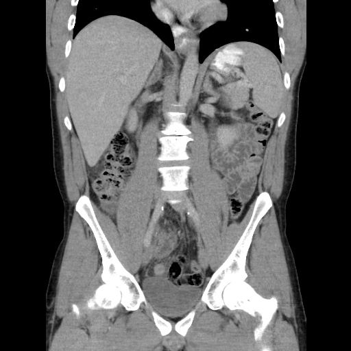 Appendicitis complicated by post-operative collection (Radiopaedia 35595-37114 B 30).jpg