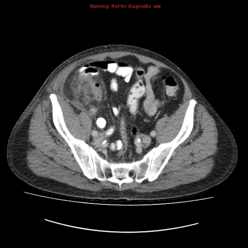 File:Appendicitis mass in inguinal hernia (Radiopaedia 26858-27029 A 13).jpg