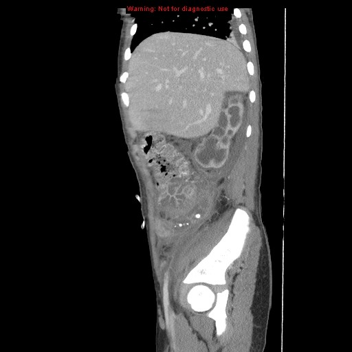 File:Appendicitis with phlegmon (Radiopaedia 9358-10046 F 10).jpg