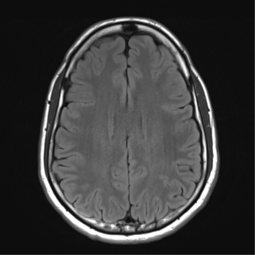 File:Arachnoid cyst - cerebellopontine angle (Radiopaedia 59689-67083 Axial FLAIR 25).png