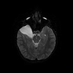 Arachnoid cyst - middle cranial fossa (Radiopaedia 67671-77088 Axial DWI 37).jpg