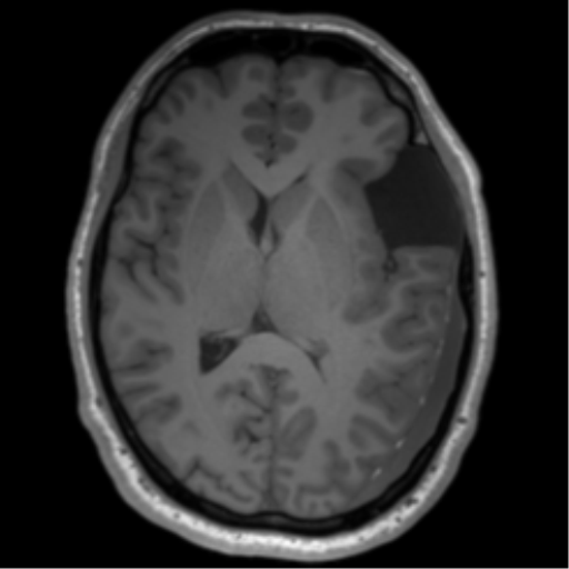 File:Arachnoid cyst with subdural hematoma (Radiopaedia 85892-101743 Axial T1 48).png