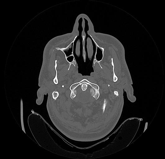 Arcuate foramen (Radiopaedia 89833-106944 Axial bone window 14).jpg