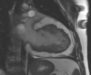 File:Arrhythmogenic right ventricular cardiomyopathy (Radiopaedia 69431-79307 2ch cine 32).jpg