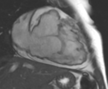 Arrhythmogenic right ventricular cardiomyopathy (Radiopaedia 69431-79307 2ch cine 60).jpg