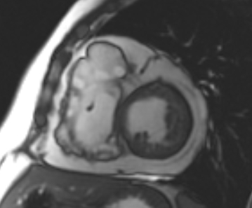 File:Arrhythmogenic right ventricular cardiomyopathy (Radiopaedia 69431-79307 Short axis cine 126).jpg
