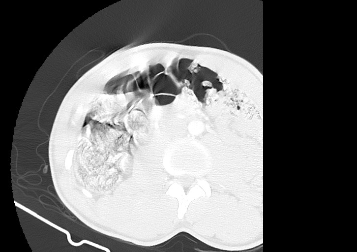 Arrow injury in the neck (Radiopaedia 75268-86390 Axial lung window 3).jpg