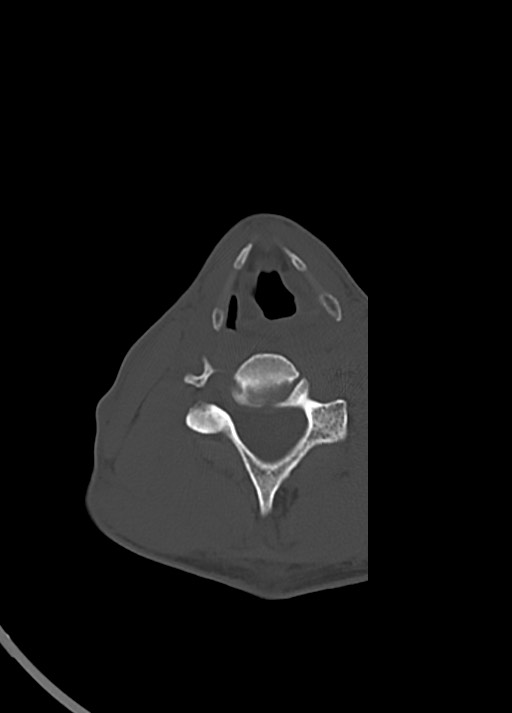 Arrow injury to the head (Radiopaedia 75266-86388 Axial bone window 1).jpg