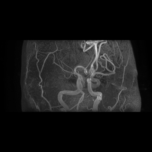 Arteriovenous malformation (Radiopaedia 71628-81999 Axial MRA 14).jpg