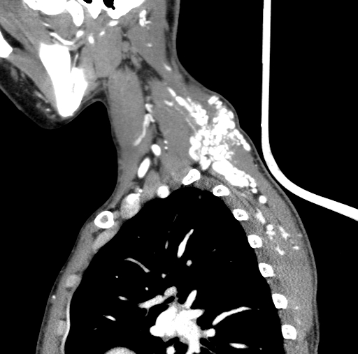 Arteriovenous malformation of the neck (Radiopaedia 53935-60062 C 25).jpg