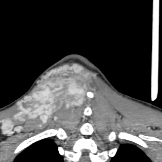 Arteriovenous malformation of the neck (Radiopaedia 53935-60062 D 56).jpg