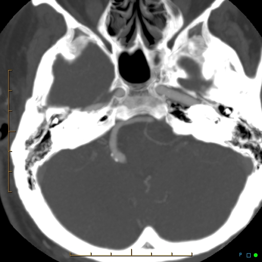 File:Artifactual basilar artery stenosis due to metallic stent (Radiopaedia 31206-31923 A 10).jpg