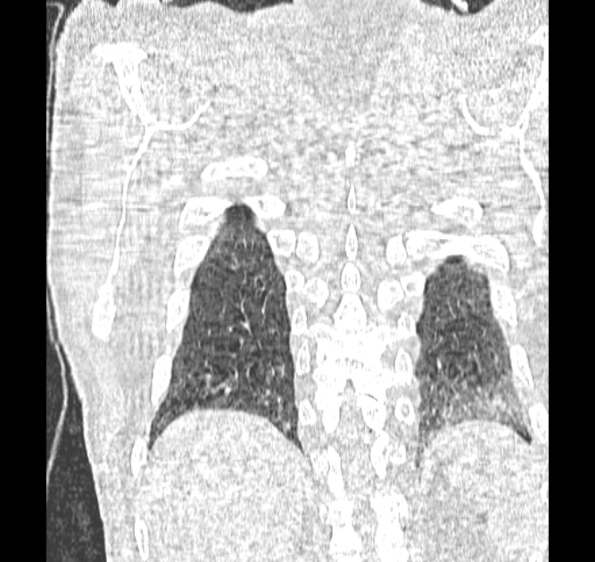 Aspergilloma (Radiopaedia 44592-48327 Coronal lung window 119).jpg