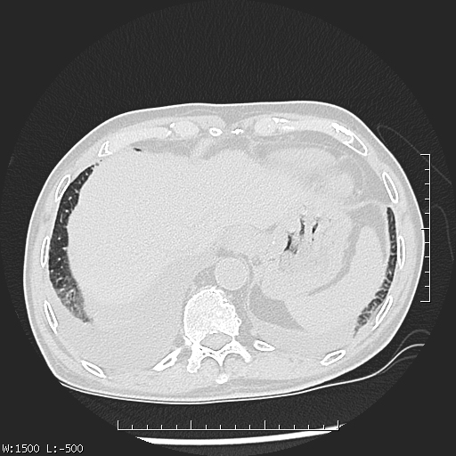 Aspergilloma (Radiopaedia 75184-86270 Axial lung window 47).jpg