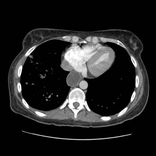 File:Aspiration pneumonia secondary to laparoscopic banding (Radiopaedia 18345-18183 A 39).jpg