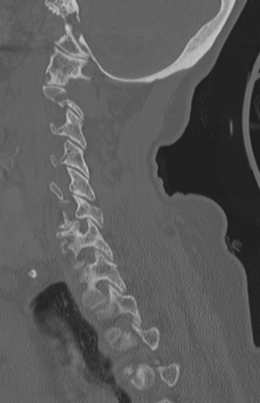 Atlanto-axial subluxation (Radiopaedia 36610-38176 Sagittal bone window 54).png