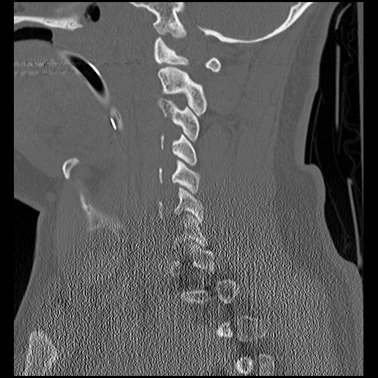 File:Atlanto-occipital dissociation injury (Radiopaedia 29274-29698 Sagittal bone window 22).png