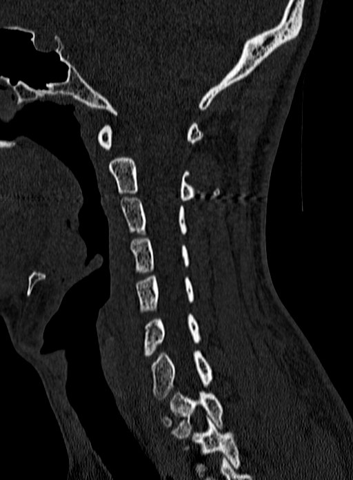 Atlantoaxial subluxation (Radiopaedia 44681-48450 Sagittal bone window 50).jpg