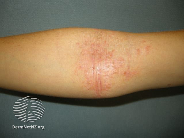 File:Atopic dermatitis (DermNet NZ dermatitis-flexural-eczema13).jpg