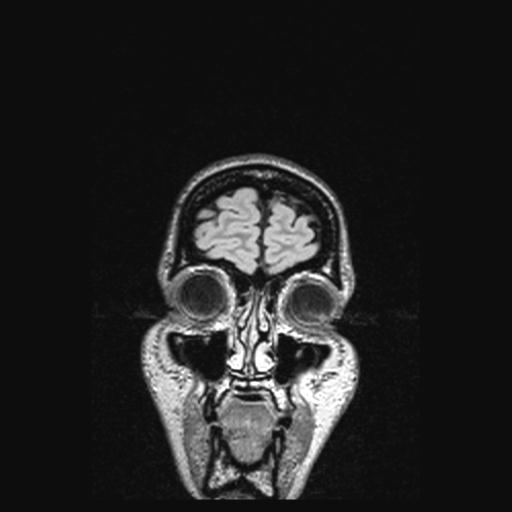 Atretic encephalocoele with inferior vermis hypoplasia (Radiopaedia 30443-31108 Coronal FLAIR 165).jpg