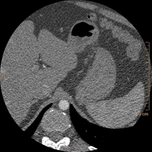 File:Atrial septal defect (upper sinus venosus type) with partial anomalous pulmonary venous return into superior vena cava (Radiopaedia 73228-83961 A 318).jpg