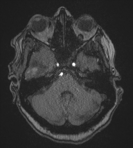 Atypical meningioma (WHO Grade II) (Radiopaedia 54742-60981 Axial MRA 25).png