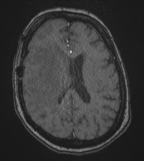 Atypical meningioma (WHO Grade II) (Radiopaedia 54742-60981 Axial MRA 62).png