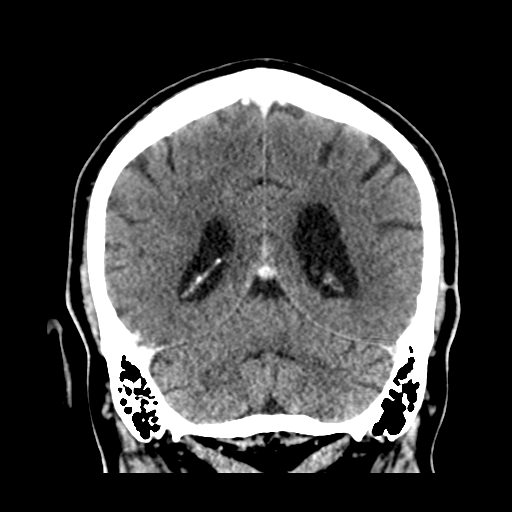 Atypical meningioma (WHO grade II) with brain invasion (Radiopaedia 57767-64728 Coronal C+ 44).png