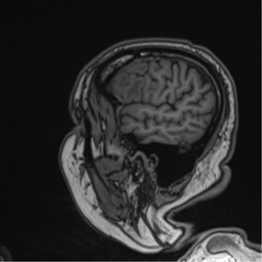 Atypical meningioma (WHO grade II) with brain invasion (Radiopaedia 57767-64729 Sagittal T1 55).png