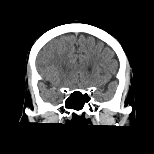 Atypical meningioma (WHO grade II) with osseous invasion (Radiopaedia 53654-59715 Coronal non-contrast 24).png