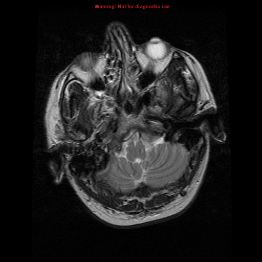 File:Atypical meningioma - grade II (Radiopaedia 13303-13305 Axial T2 4).jpg
