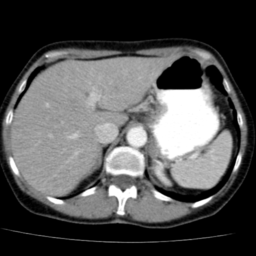 File:Atypical renal cyst (Radiopaedia 17536-17251 renal cortical phase 4).jpg