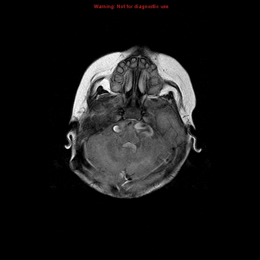 File:Atypical teratoid rhabdoid tumor (Radiopaedia 10712-11183 Axial FLAIR 14).jpg