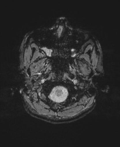 Autoimmune limbic encephalitis (Radiopaedia 30363-31005 SWI - magnitude 5).jpg