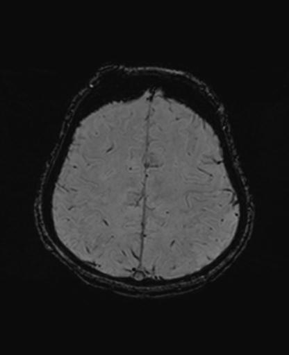 Autoimmune limbic encephalitis (Radiopaedia 30363-31005 SWI 62).jpg