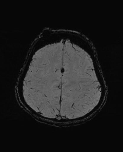 Autoimmune limbic encephalitis (Radiopaedia 30363-31005 SWI 63).jpg
