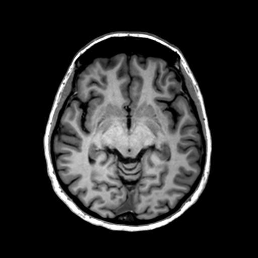 Autoimmune limbic encephalitis (Radiopaedia 30363-31005 T1 Axial 1mm 69).jpg